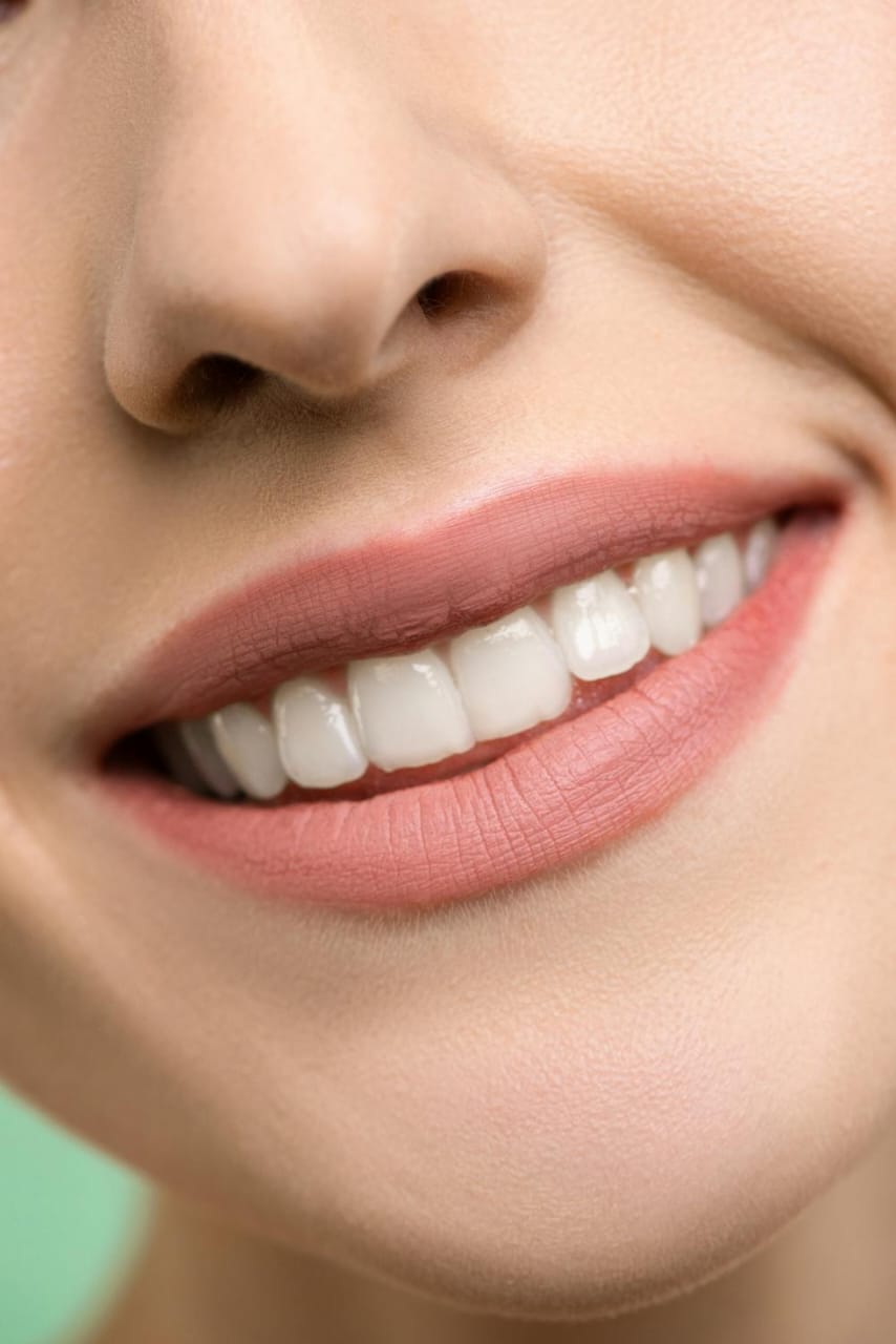 clareamento Dental a Laser